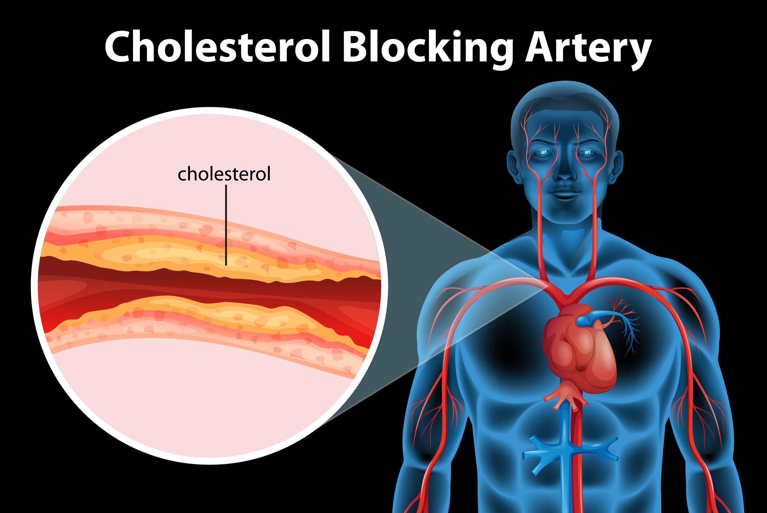 Cholesterol Blocking Artery